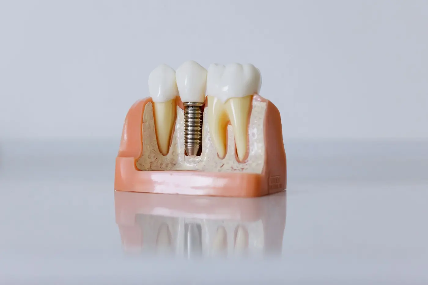 Kesit diş modelinde implant ve doğal dişler